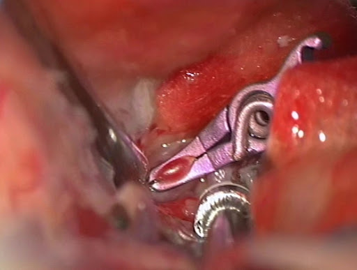 Cirugía de Aneurisma cerebral en Neurocirugía Almenara Perú