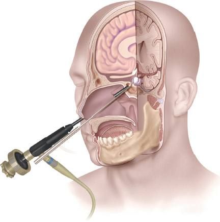 Novedosa Técnica de Cirugía Endoscópica Endonasal para Tumores de Hipófisis en Neurocirugía Almenara Perú