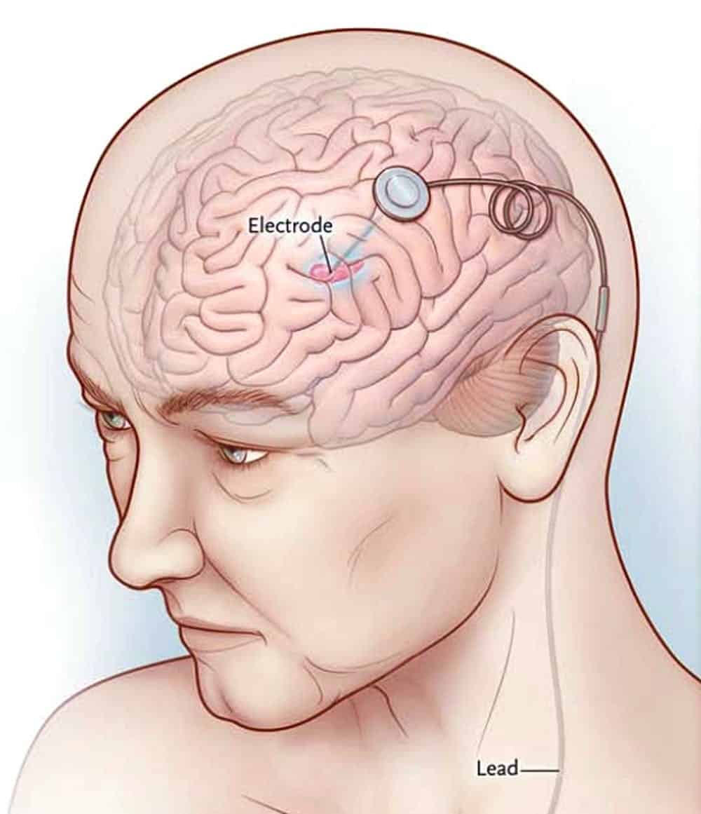 Cirugía cerebral de Parkinson en Neurocirugía Almenara Perú