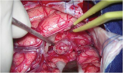 Cirugía de Aneurisma cerebral en Neurocirugía Almenara Perú