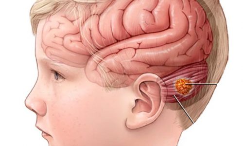 Cirugía de tumor cerebral en niños, Neurocirugía Almenara