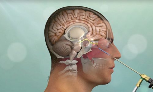 Cirugía endoscópica endonasal, Dr Jerson Flores, Neurocirugía Almenara