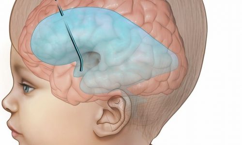 Neuroendoscopia en hidrocefalia en niños, Neurocirugía Almenara