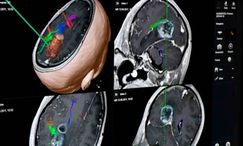 Cirugía de Tumor Cerebral en Neurocirugía Almenara Perú